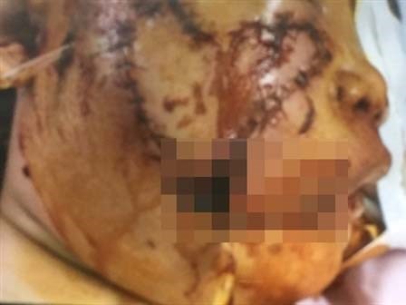 Thương tâm bé gái 5 tuổi bị chó cắn nát nửa khuôn mặt, lộ cả hai hàm răng