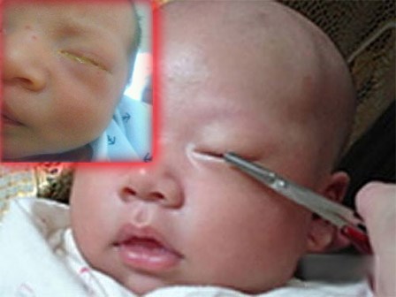 Người mẹ sốc nặng khi biết nguyên nhân mắt con nhỏ sưng húp, chảy mủ