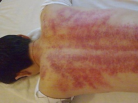 Giúp chồng cạo gió, chồng đột ngột hôn mê rồi qua đời