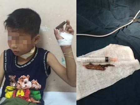 Bé 9 tuổi bị cành cây đâm xuyên cổ