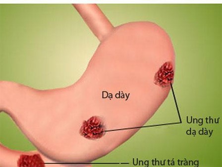 PGĐ Bệnh viện Việt Đức: Cảnh báo 2 nguyên nhân khiến người Việt mắc ung thư dạ dày