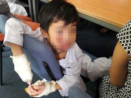 Bé trai bị điện giật chỉ còn 5 ngón tay lành lặn trong ngày xuất viện