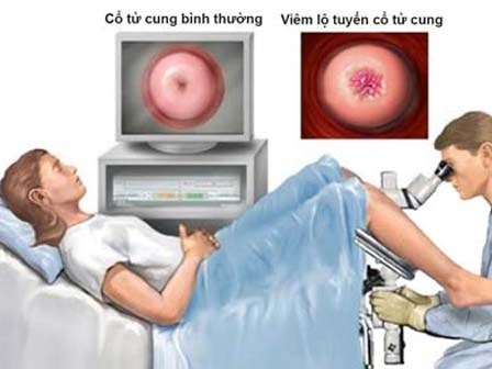 Đốt lộ tuyến tử cung có ảnh hưởng đến khả năng làm mẹ?