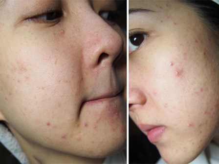 Cẩm nang da mụn: Nguyên nhân và cách triệt hạ tận gốc các nốt mụn đáng ghét