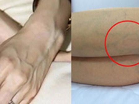Phụ nữ chớ nên coi thường việc nổi gân xanh trên cơ thể, nhất là trên chân