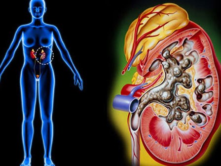 Ngộ độc vì tự chữa sỏi thận bằng kim tiền thảo