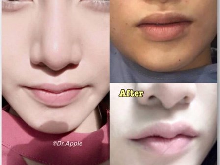 Bất chấp tai biến, nhiều chị em 'bạo tay' chi tiền để làm môi sừng trâu