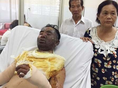 Mâu thuẫn vợ đổ dầu nóng khiến chồng nguy kịch