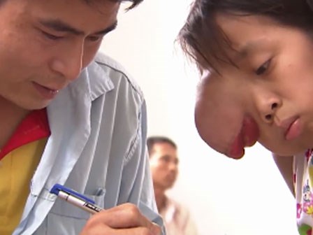 Xót xa cảnh gia cảnh bé gái có khối u che nửa mặt: Con ăn mỳ, bố húp nước cầm cự