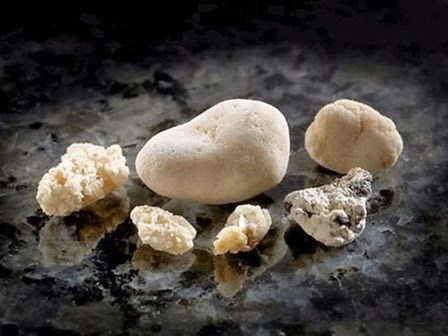 Những cách chữa sỏi thận tự nhiên rất hiệu quả