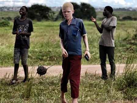 Nỗi sợ bị chặt tay chân của người bạch tạng Malawi