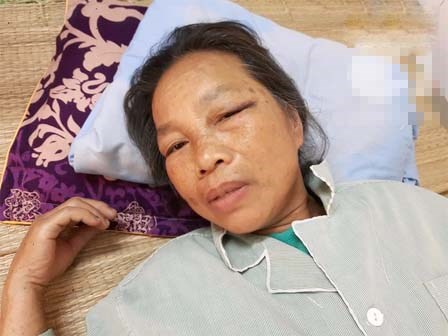 Bà lão gần 70 tuổi bị em trai dùng xẻng tấn công khiến nhập viện cấp cứu