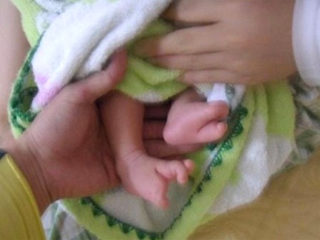 Xót thương bé sơ sinh chào đời với hình dạng bàn tay, bàn chân giống như càng cua