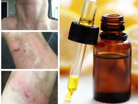 Hậu quả khôn lường của việc sử dụng tinh dầu không đúng cách