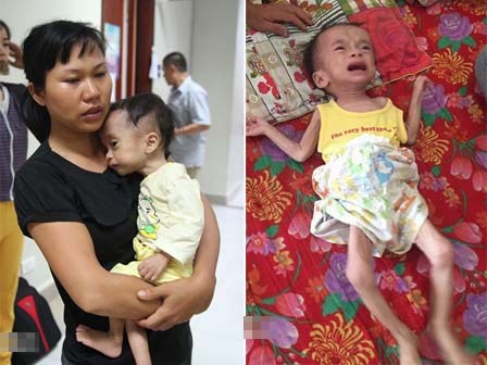 Xót xa hình ảnh em bé sinh ra nặng 4kg, sau một năm chỉ còn 3,4kg