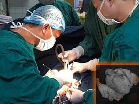 Bé trai 10 tháng tuổi bị khối u khổng lồ chèn ép khiến phổi bẹp như tờ giấy
