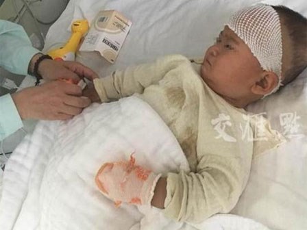 Bất mãn vì bị chồng bạo hành, mẹ cắn con 1 tuổi trọng thương