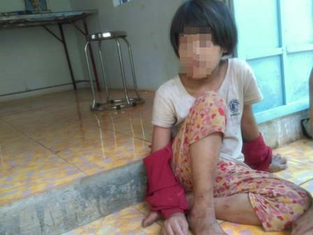 Tương lai mờ mịt của bé gái từng bị mẹ cắt gân chân