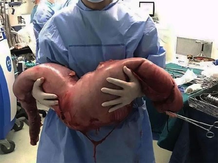 Mổ bụng bệnh nhân, bác sĩ tá hỏa khi phát hiện khối đại tràng dài 76cm do bị táo bón nhiều năm