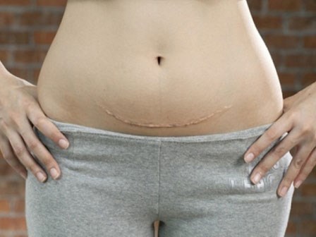 Chửa trên vết mổ: Bệnh lý nguy hiểm có thể cướp đi sinh mạng của bà bầu bất cứ lúc nào