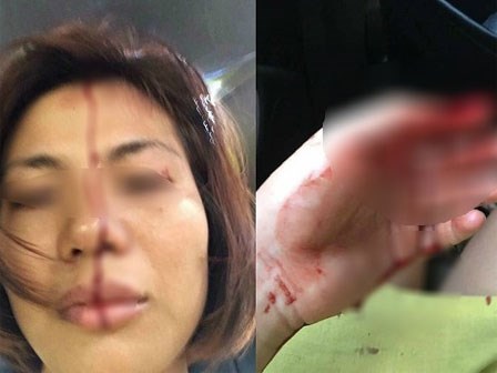 Hà Nội: Người phụ nữ tố bị chồng cũ đánh đập, bạo hành dã man