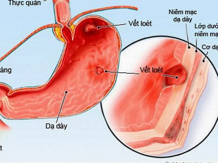 Tưởng con bị giun hoá ra viêm loét dạ dày vì lây vi khuẩn HP từ mẹ