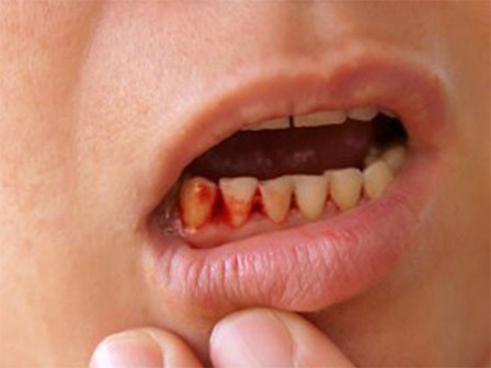 Mệt mỏi, chảy máu chân răng: dấu hiệu của bệnh cực kỳ nguy hiểm
