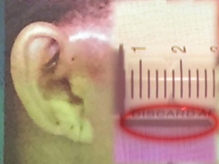 Mổ lấy tăm nằm trong tai bệnh nhân hơn một năm