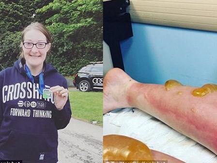 Chạy 111km trong 21 tiếng dưới trời nắng nóng, người phụ nữ bị phồng rộp kinh hoàng