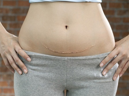 Sử dụng giác hút hỗ trợ khi đẻ thường, mẹ đau đớn nhìn con mang sẹo cả đời-1