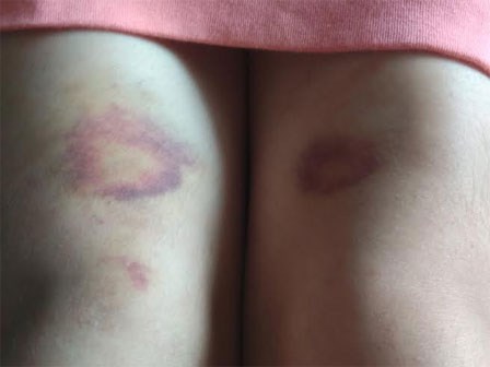 Chủ cửa hàng gội đầu đánh khách chấn thương sọ não