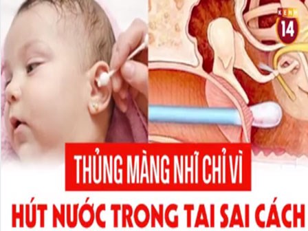 Thủng màng nhĩ chỉ vì hút nước tai sai cách