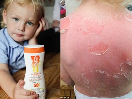 Dùng kem chống nắng SPF 50 đi dã ngoại, bé trai 3 tuổi bị cháy nắng và phồng rộp nghiêm trọng