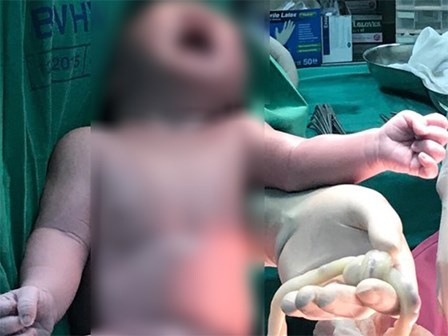 Hi hữu: Bé trai chào đời với vòng dây rốn thắt nút