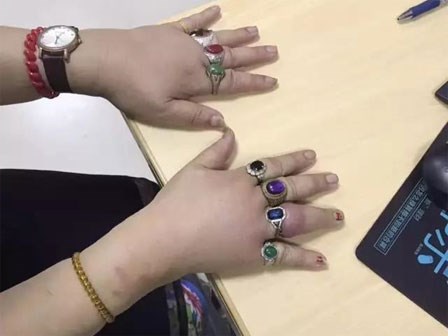 Đeo nhẫn đủ 10 ngón tay, người phụ nữ thích khoe của khóc tu tu gọi đội cứu hộ vì không tháo ra được