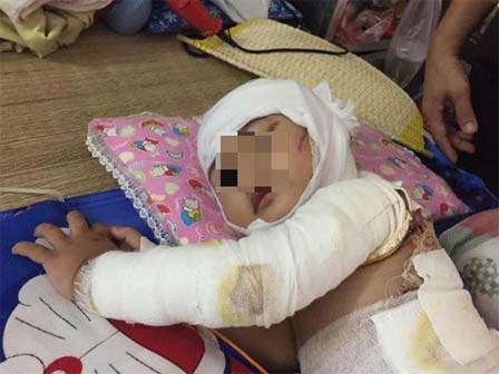Bé gái 2 tuổi bỏng toàn thân, phẫu thuật 4 lần/tháng vì hóa chất thông cống dính vào người