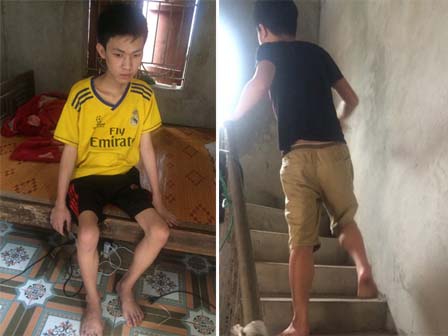 Chàng trai người cá lạc quan ở Hà Nội: Nhìn thấy bộ dạng của mình, nhiều người hỏi sao không chết đi, sống để làm gì?-17