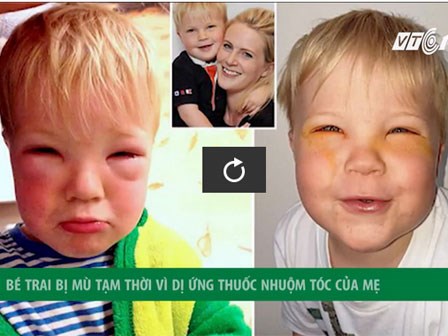 Bé trai 2 tuổi bị mù tạm thời vì mẹ nhuộm tóc