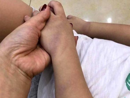 Xôn xao bé trai 3 tuổi ở Hải Dương bị giáo viên đánh bầm tím chân tay