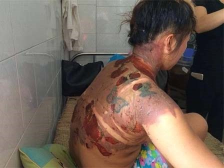 Dội nước sôi vào người vợ rồi thản nhiên bỏ đi
