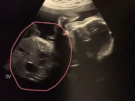 Đang siêu âm thai, cặp đôi bị sốc khi nhìn thấy hình ảnh xuất hiện trên màn hình