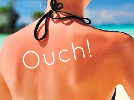 6 mẹo ngay lập tức xoa dịu làn da bỏng rát do cháy nắng