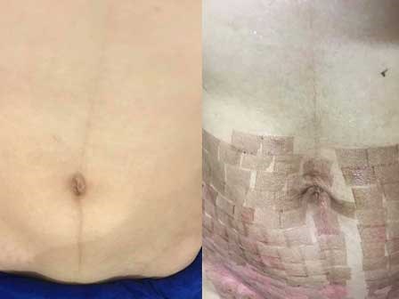 Chi 15 triệu làm đẹp sau sinh ở spa, mẹ trẻ bị bắn laser chín thịt, bụng chi chít sẹo bỏng