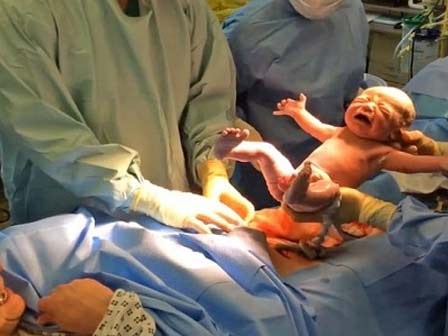 Thót tim với khoảnh khắc đẹp em bé bật tung người ra khỏi bụng mẹ bằng sinh mổ