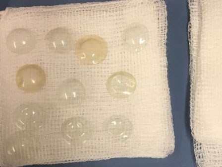 Phẫu thuật đục thủy tinh thể, bác sĩ tá hỏa khi phát hiện trong mắt bệnh nhân có tới 27 kính áp tròng