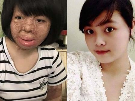 Cô gái bị chồng tẩm xăng đốt: