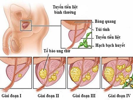 Làm sao để phát hiện ung thư tuyến tiền liệt đang tấn công bạn?