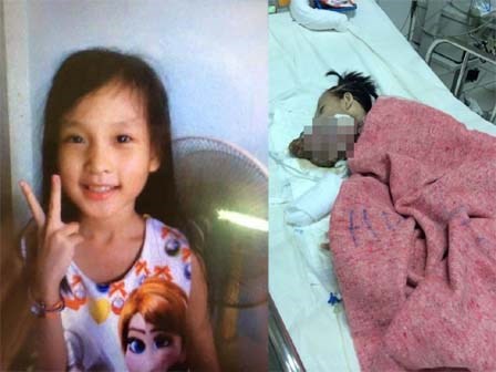 Chuỗi ngày đau đớn của bé gái 11 tuổi, mồ côi cha, bị khối u quái ác che kín mặt