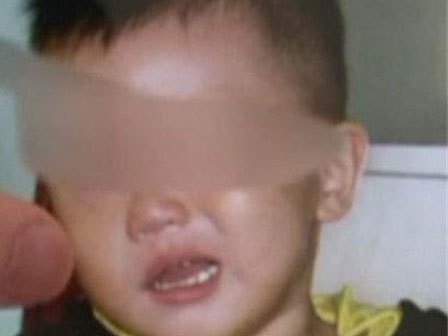 Nằm điều hòa quá lạnh, cô gái trẻ bị méo mồm, liệt mặt phải nhập viện điều trị-2