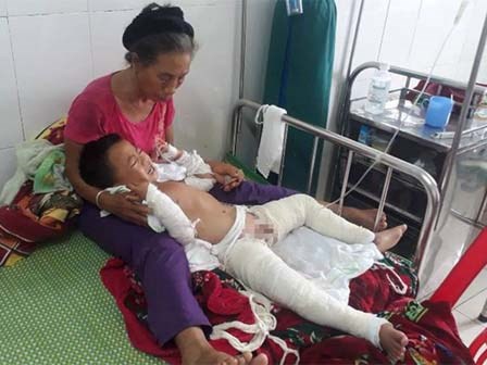 Nghịch xăng, bé 4 tuổi cháy xém từ bụng đến chân